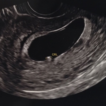 embarazo-6-semana