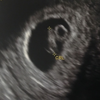 embarazo-6.6-semanas