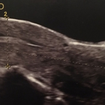 utero-de-11.5×3.4-cm-y-un-endometrio-de-6-mm.